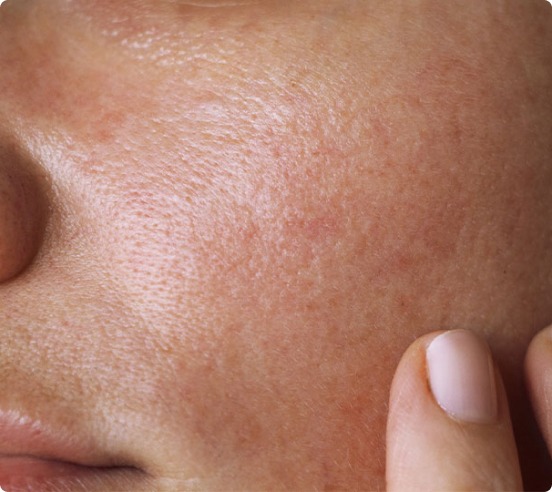 formulating-beauty-products-sensitive-skin